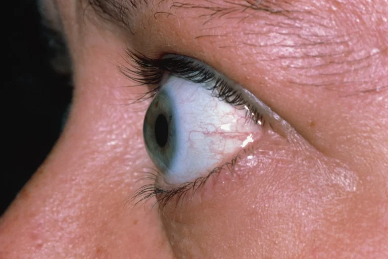 علاج جحوظ العين في شيراز: التشخيص أولاً 1 Bulging eyes exophthalmos 1.jpg