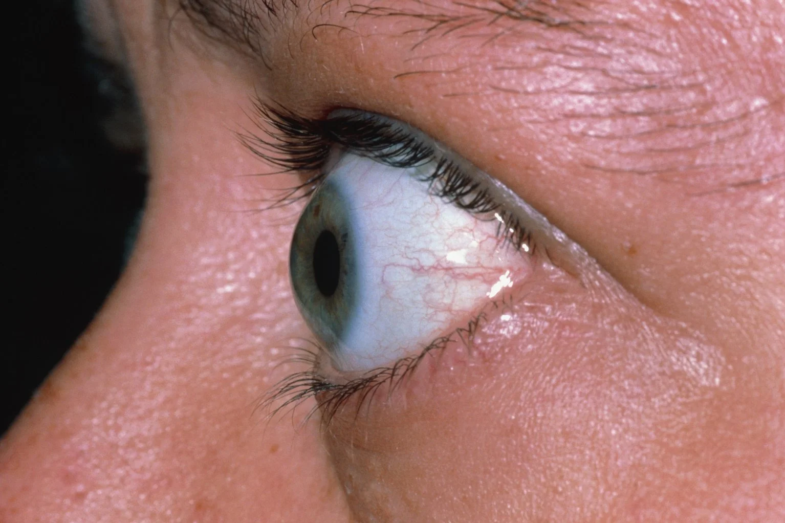 Bulging eyes exophthalmos 1.jpg