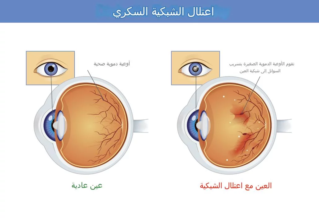 Diabetic Retinopathy 1.jpg