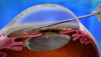 طب العيون في شيراز 6 Glaucoma Surgery