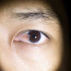 Pterygium Treatment in iran