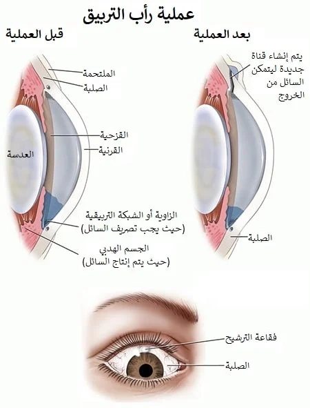 عملية الماء الأزرق في إيران 4 Trabeculectomy.jpg
