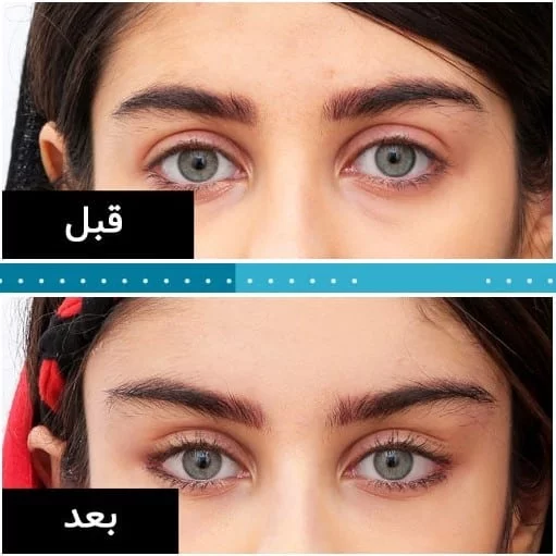عملية عيون القطط في ايران | افضل دكتور تجميل وتكلفة | سنا مدتور 5 ba blepharo 1.jpg