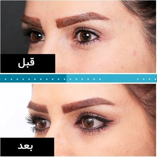 عملية عيون القطط في ايران | افضل دكتور تجميل وتكلفة | سنا مدتور 3 ba blepharo 3.jpg