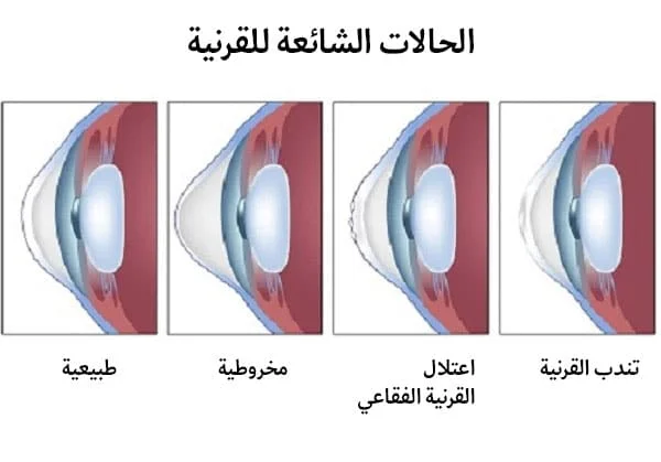 زراعة القرنية في إيران 2 corneal diseases.jpg