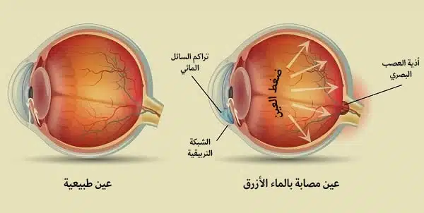 عملية الماء الأزرق في إيران 2 glaucoma surgery.jpg