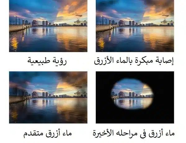 عملية الماء الأزرق في إيران 3 glaucoma symptoms.jpg