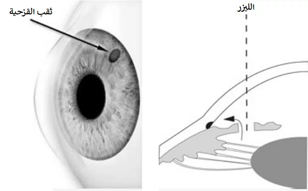 عملية الماء الأزرق في إيران 5 iridotomy.png