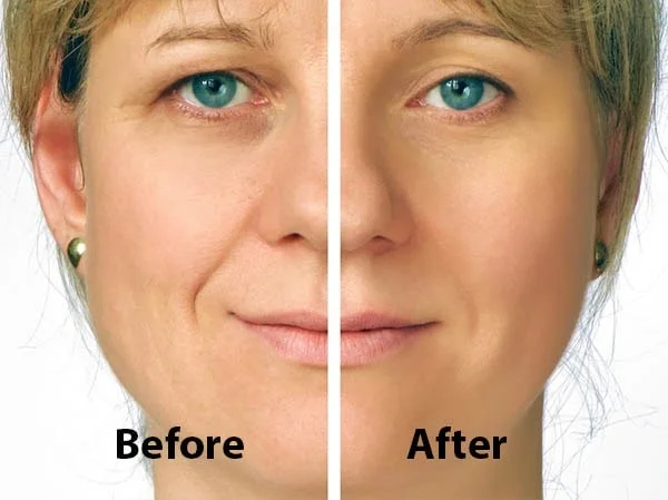 تجميل العيون في ايران 4 oculoplastic surgery before after.jpg